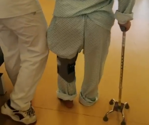 【案例996】多维康复治疗下，用时82天，患者从“步履蹒跚、表达困难”到“步态稳